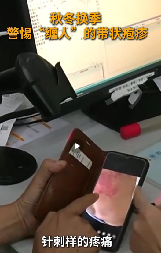 最疼皮肤病” 通常指的是带状疱疹，目前已进入高发期